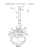 FLOATING SPINAL CANNULA AND METHOD OF USE diagram and image
