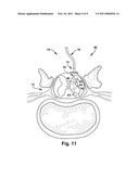 FLOATING SPINAL CANNULA AND METHOD OF USE diagram and image