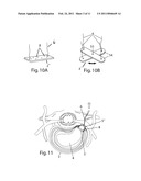 SYSTEM AND DEVICES FOR THE REPAIR OF A VERTEBRAL DISC DEFECT diagram and image