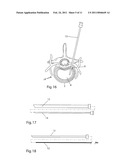 SYSTEM AND DEVICES FOR THE REPAIR OF A VERTEBRAL DISC DEFECT diagram and image