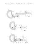 SYSTEM AND DEVICES FOR THE REPAIR OF A VERTEBRAL DISC DEFECT diagram and image