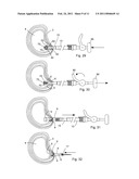 SYSTEM AND DEVICES FOR THE REPAIR OF A VERTEBRAL DISC DEFECT diagram and image