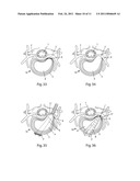 SYSTEM AND DEVICES FOR THE REPAIR OF A VERTEBRAL DISC DEFECT diagram and image