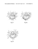 SYSTEM AND DEVICES FOR THE REPAIR OF A VERTEBRAL DISC DEFECT diagram and image