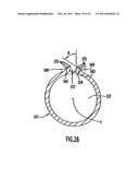 Instruments and Methods for Minimally Invasive Carpal Tunnel Release diagram and image