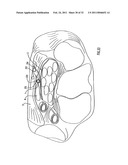 Instruments and Methods for Minimally Invasive Carpal Tunnel Release diagram and image