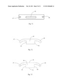 Laminoplasty System diagram and image