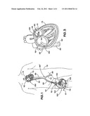 Apparatus for Implanting an Aortic Valve Prosthesis diagram and image