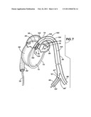 Apparatus for Implanting an Aortic Valve Prosthesis diagram and image