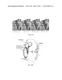 METHOD AND APPARATUS FOR IN-SITU ADJUSTABILITY OF A MIDDLE EAR PROSTHESIS diagram and image