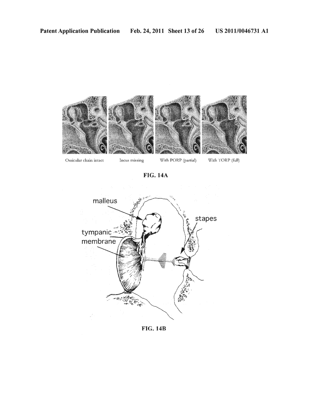 METHOD AND APPARATUS FOR IN-SITU ADJUSTABILITY OF A MIDDLE EAR PROSTHESIS - diagram, schematic, and image 14