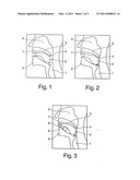 ANTI-SNORING DEVICE diagram and image