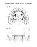 HUMAN BODY IMPLANT STRUCTURE, METHOD OF ASSEMBLING THE STRUCTURE AND METHOD OF DISASSEMBLING THE STRUCTURE diagram and image