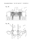 HUMAN BODY IMPLANT STRUCTURE, METHOD OF ASSEMBLING THE STRUCTURE AND METHOD OF DISASSEMBLING THE STRUCTURE diagram and image