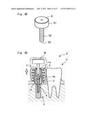 HUMAN BODY IMPLANT STRUCTURE, METHOD OF ASSEMBLING THE STRUCTURE AND METHOD OF DISASSEMBLING THE STRUCTURE diagram and image