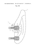 HUMAN BODY IMPLANT STRUCTURE, METHOD OF ASSEMBLING THE STRUCTURE AND METHOD OF DISASSEMBLING THE STRUCTURE diagram and image