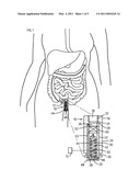 Implantable Device for Controlling Defecation and Related Method diagram and image