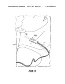 CEREBROSPINAL FLUID EVALUATION SYSTEM HAVING THERMAL FLOW AND FLOW RATE MEASUREMENT PAD USING A PLURALITY OF CONTROL SENSORS diagram and image