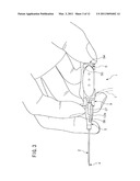 INDWELLING NEEDLE ASSEMBLY AND METHOD OF USING THE SAME diagram and image