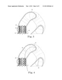 Paravalvular Leak Closure Devices and Methods diagram and image