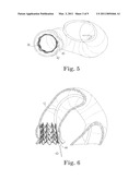 Paravalvular Leak Closure Devices and Methods diagram and image