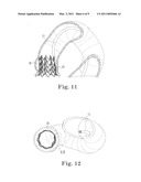 Paravalvular Leak Closure Devices and Methods diagram and image