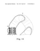 Paravalvular Leak Closure Devices and Methods diagram and image