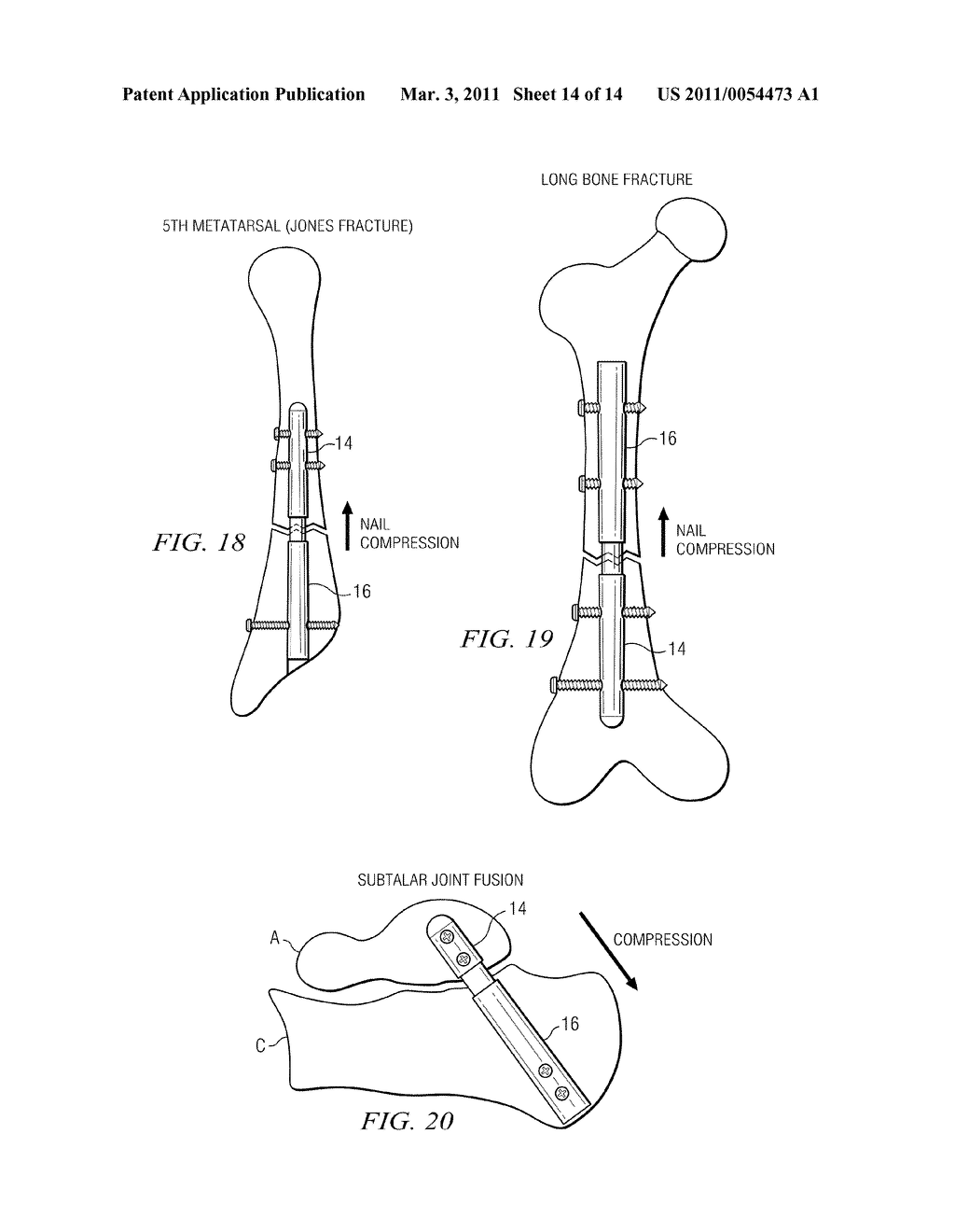 ANKLE ARTHRODESIS NAIL AND OUTRIGGER ASSEMBLY - diagram, schematic, and image 15