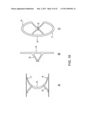 METHOD FOR CLOSING AN APERTURE IN A PATIENT S BODY diagram and image