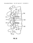 FUSION METHOD AND PEDICLE ACCESS TOOL diagram and image