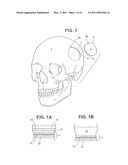 Craniotomy Closures and Plugs diagram and image