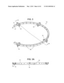 Craniotomy Closures and Plugs diagram and image