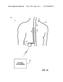 DORSAL COLUMN STIMULATION THERAPY diagram and image