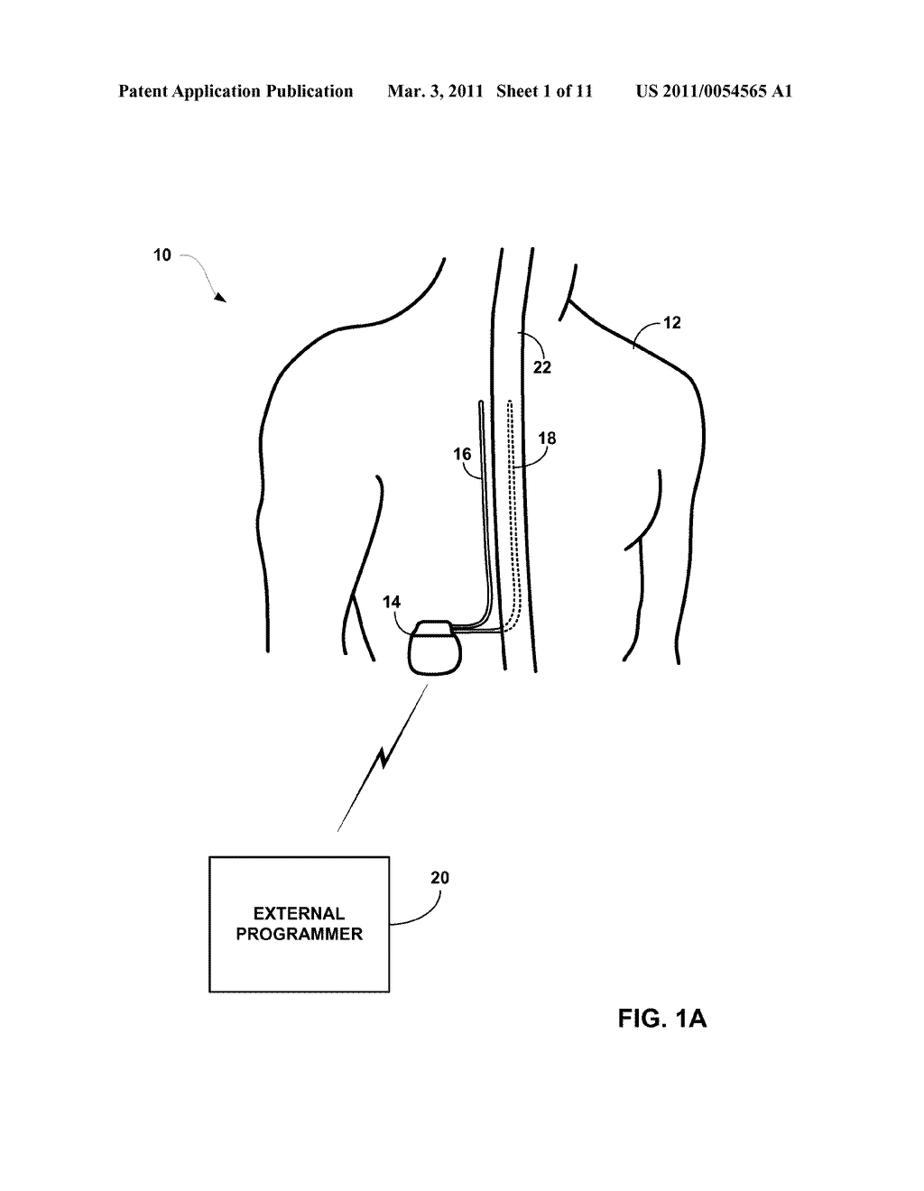 DORSAL COLUMN STIMULATION THERAPY - diagram, schematic, and image 02