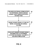 DORSAL COLUMN STIMULATION THERAPY diagram and image