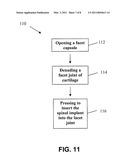 SPINAL IMPLANT AND METHOD diagram and image