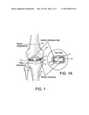 Tissue Engineered Meniscus Repair Composition diagram and image