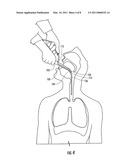 INSERTION AID FOR ORAL AND NASAL MEDICAL DEVICES diagram and image