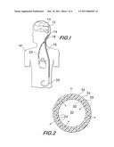 IMPLANTABLE SHUNT OR CATHETER ENABLING GRADUAL DELIVERY OF THERAPEUTIC AGENTS diagram and image