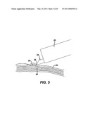 METHODS AND IMPLANTS FOR INDUCING SATIETY IN THE TREATMENT OF OBESITY diagram and image