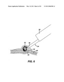 METHODS AND IMPLANTS FOR INDUCING SATIETY IN THE TREATMENT OF OBESITY diagram and image