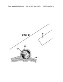 METHODS AND IMPLANTS FOR INDUCING SATIETY IN THE TREATMENT OF OBESITY diagram and image