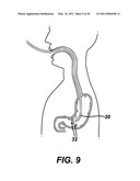 METHODS AND IMPLANTS FOR INDUCING SATIETY IN THE TREATMENT OF OBESITY diagram and image