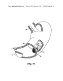 METHODS AND IMPLANTS FOR INDUCING SATIETY IN THE TREATMENT OF OBESITY diagram and image