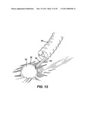 METHODS AND IMPLANTS FOR INDUCING SATIETY IN THE TREATMENT OF OBESITY diagram and image