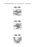 METHODS AND IMPLANTS FOR INDUCING SATIETY IN THE TREATMENT OF OBESITY diagram and image