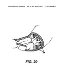 METHODS AND IMPLANTS FOR INDUCING SATIETY IN THE TREATMENT OF OBESITY diagram and image