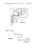 Implantable Device for Controlled Drug Delivery diagram and image
