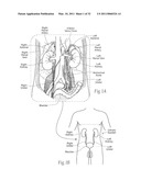 APPARATUS, SYSTEMS, AND METHODS FOR ACHIEVING INTRAVASCULAR, THERMALLY-INDUCED RENAL NEUROMODULATION diagram and image