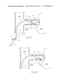 APPARATUS, SYSTEMS, AND METHODS FOR ACHIEVING INTRAVASCULAR, THERMALLY-INDUCED RENAL NEUROMODULATION diagram and image